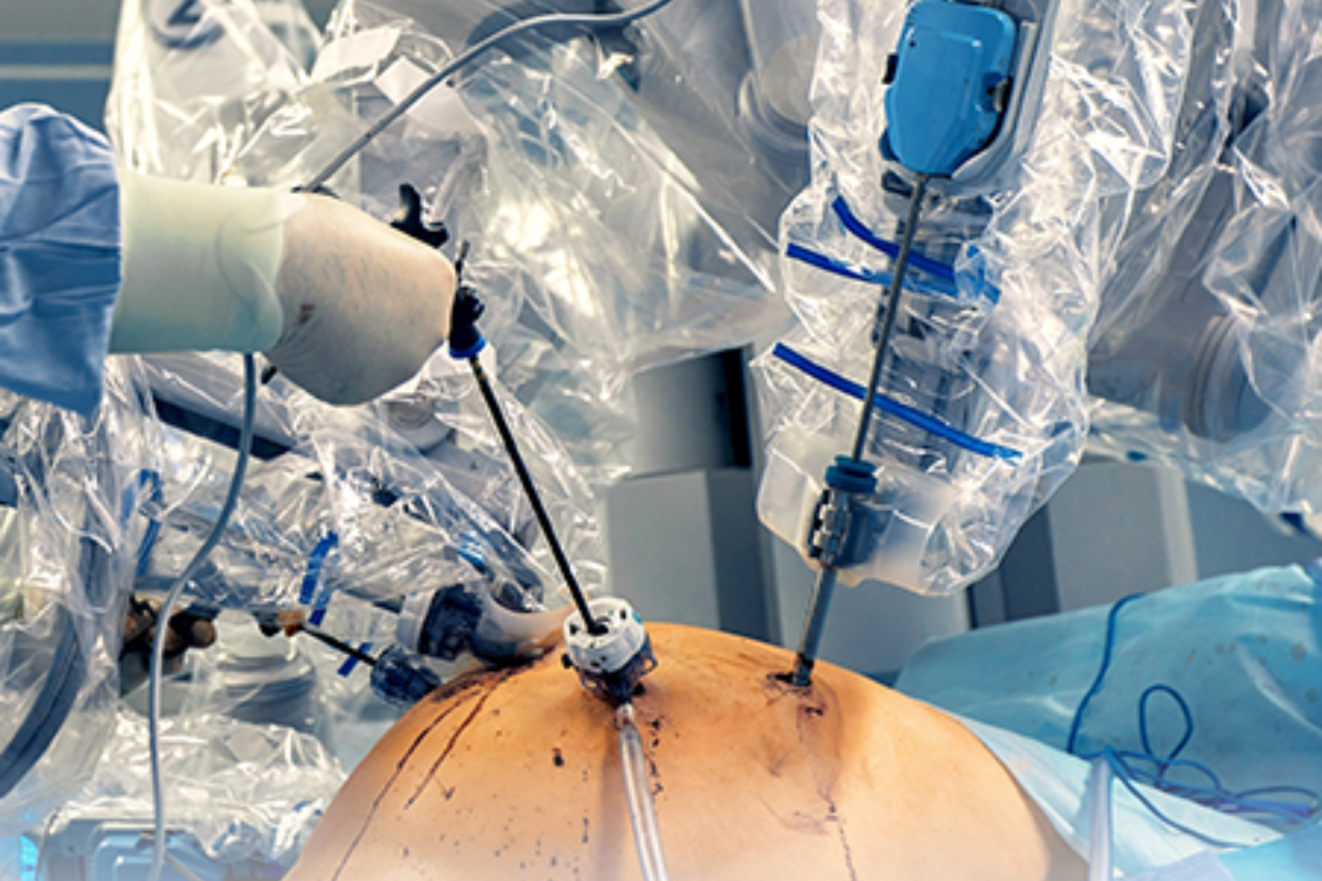 Robotic Surgery